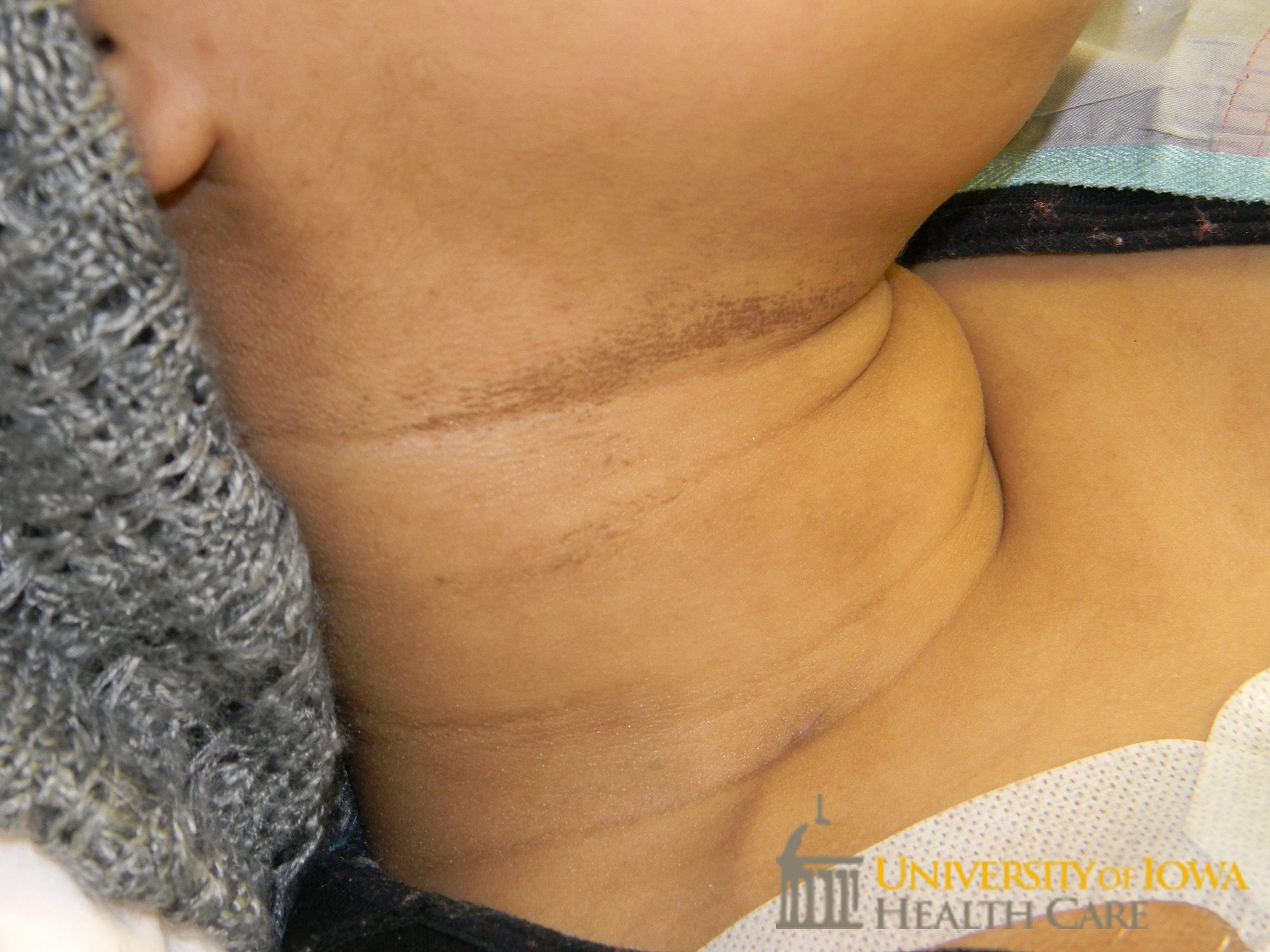 Brown macules coalescing into patches on the neck flexural folds. (click images for higher resolution).
